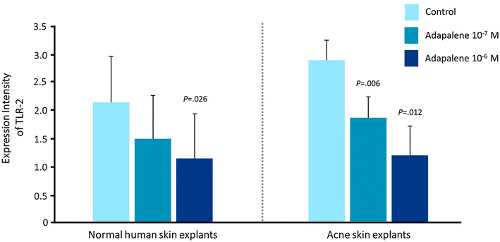 From Retinoids to Extraction: Treating Comedonal Acne Effectively